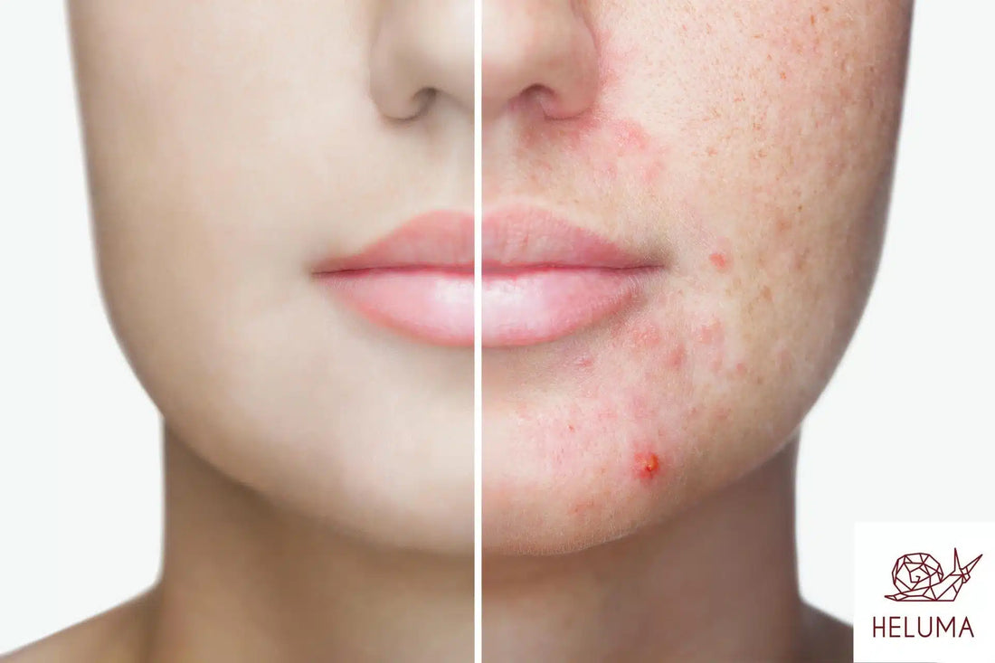 Crema bava delle lumache acne